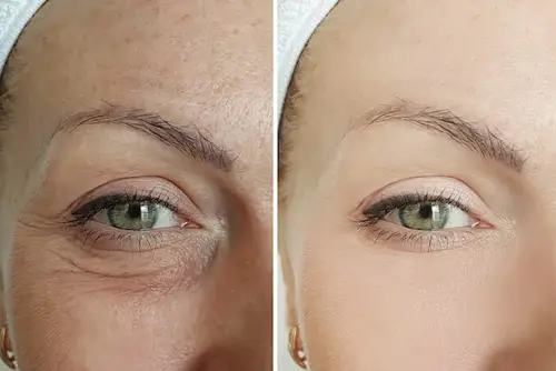 before and after NunaWave Wand using on eyes