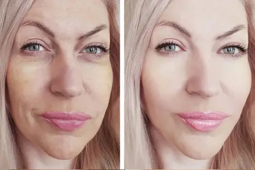 before and after NunaWave Wand using on face