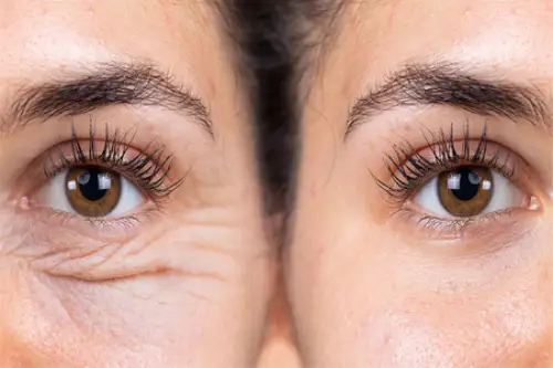 before and after using NunaWave Wand on eyes